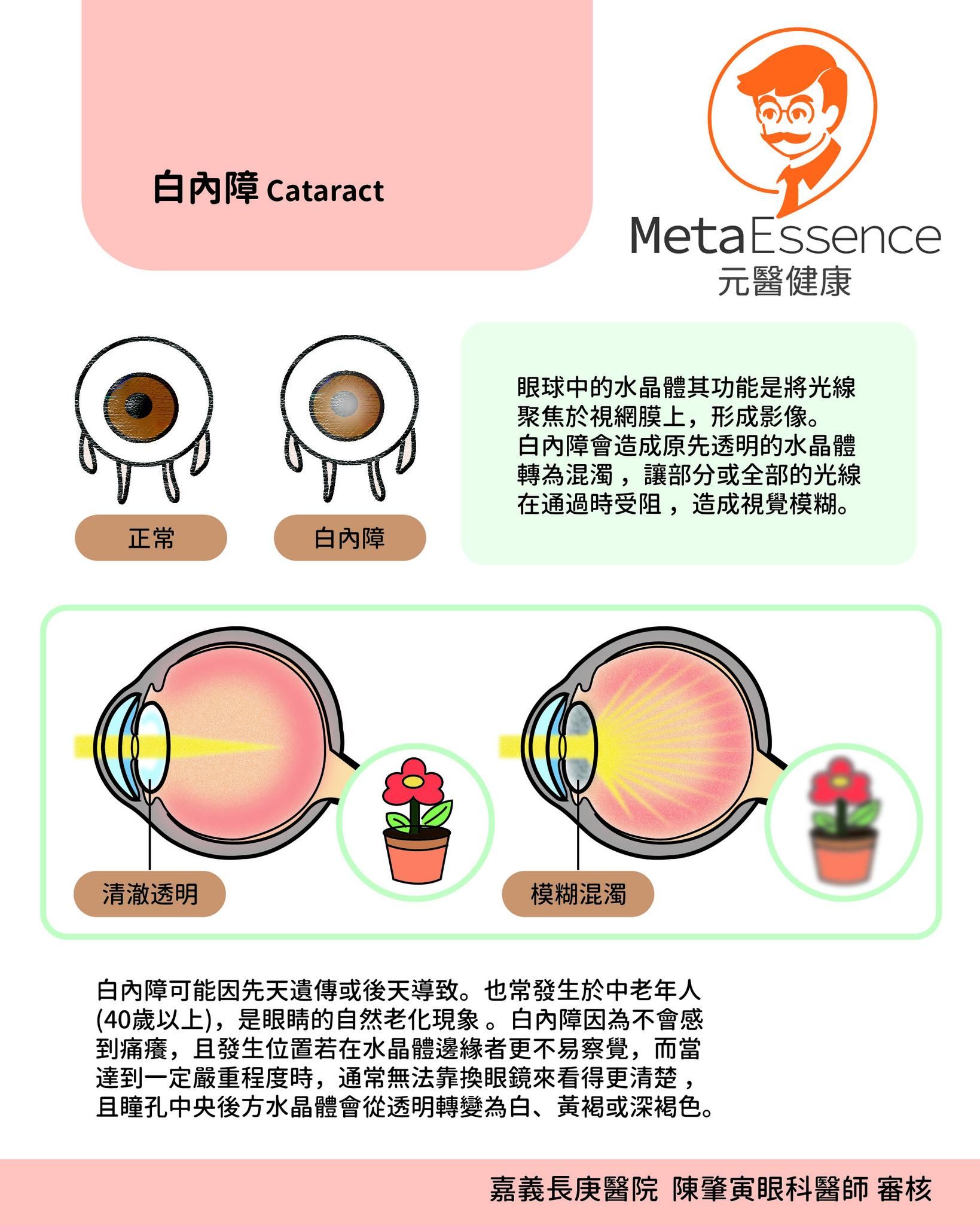 白內障